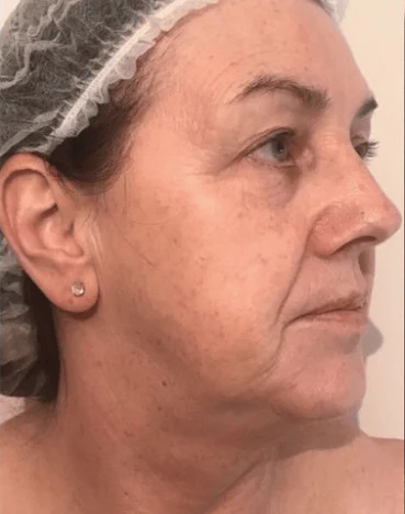 Before treatment